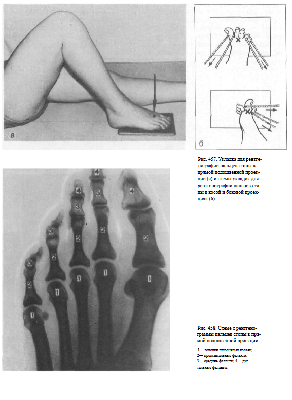 Рентгенограммы костей при переломах пальцев стоп