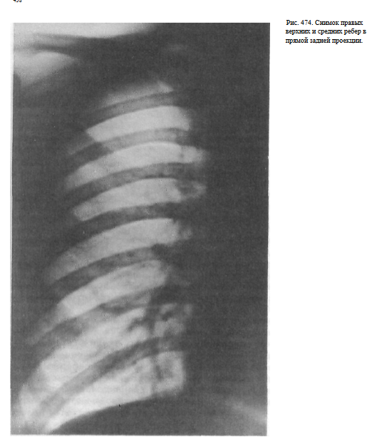 Рентгенограмма при переломе ребер
