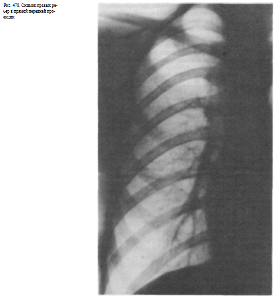 Перелом ребра рентген фото