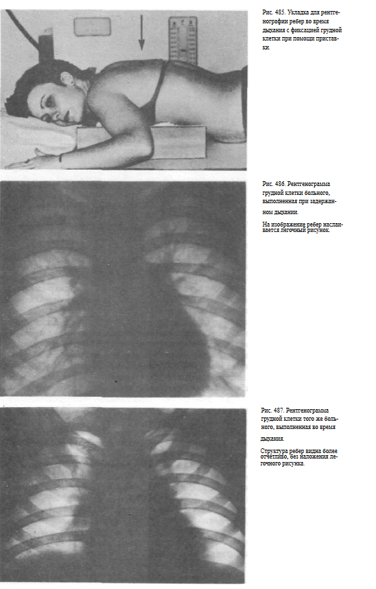 Рентгенограмма при переломе ребер