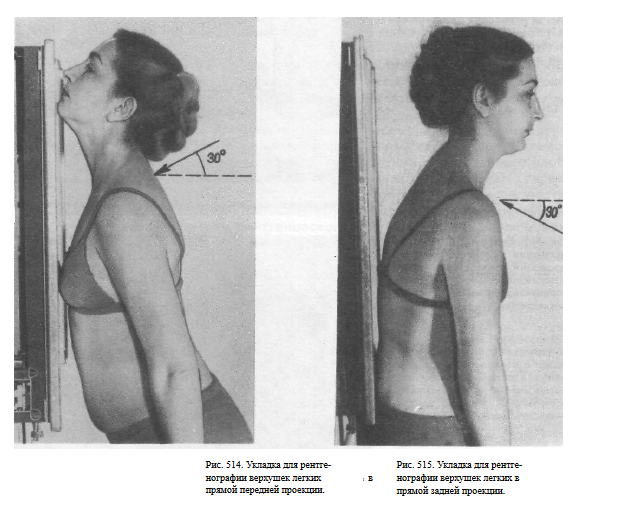 Рентген стоя. Рентгенография верхушек легких по Флейшнеру. Укладка по Флейшнеру рентген. Задняя проекция легких по Флейшнеру. Рентген ОГК укладка.