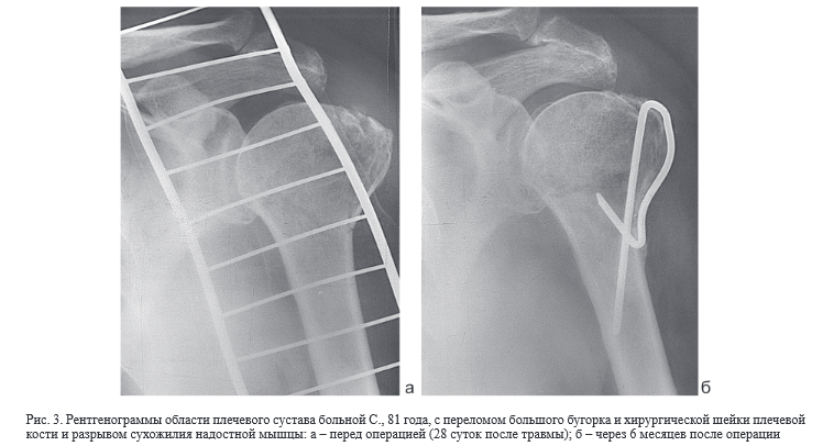 Перелом большого бугорка плечевой кости форум