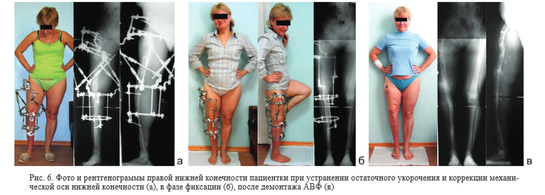 Артроз коленного сустава: причины, симптомы, как лечить без медикаментов