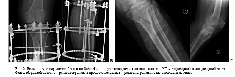 Перелом большеберцовой кости с аппаратом илизарова
