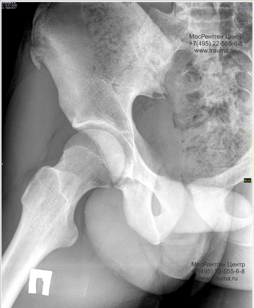 Норма рентгенограммы тазобедренного сустава