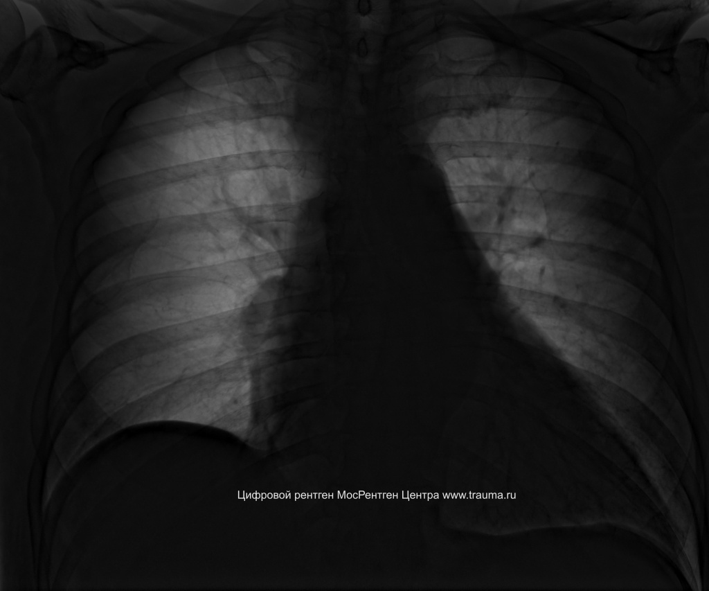 Тромбоэмболия легочной артерии на рентгене