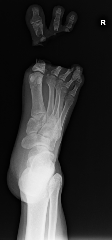 traumatic-toe-amputation7.jpg