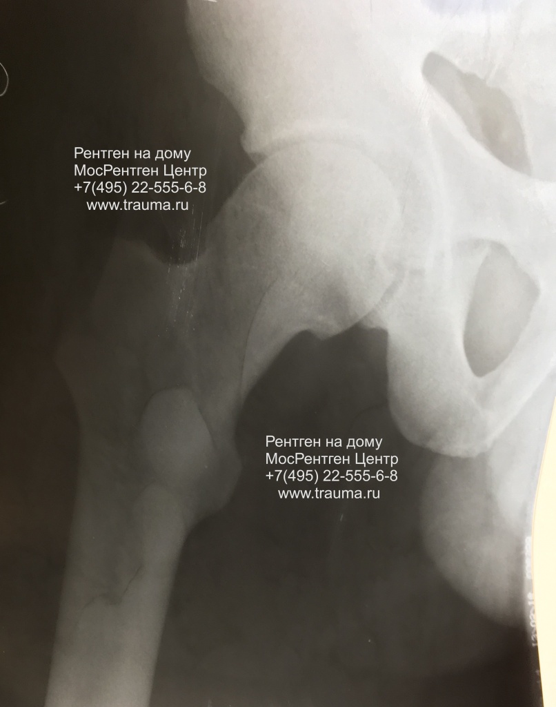 Рентген тазобедренного сустава без растра