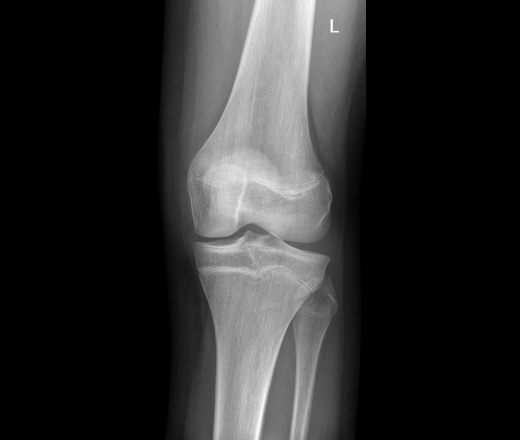 Рентгенограмма коленного сустава с зонами роста
