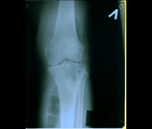 боли в левом коленном суставе, левой голени, На рентгенограмме, межтканевая эмфизема, инфицированная флегмона 