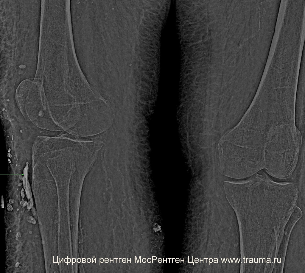 Рентген коленного сустава при переломе шейки бедра справа