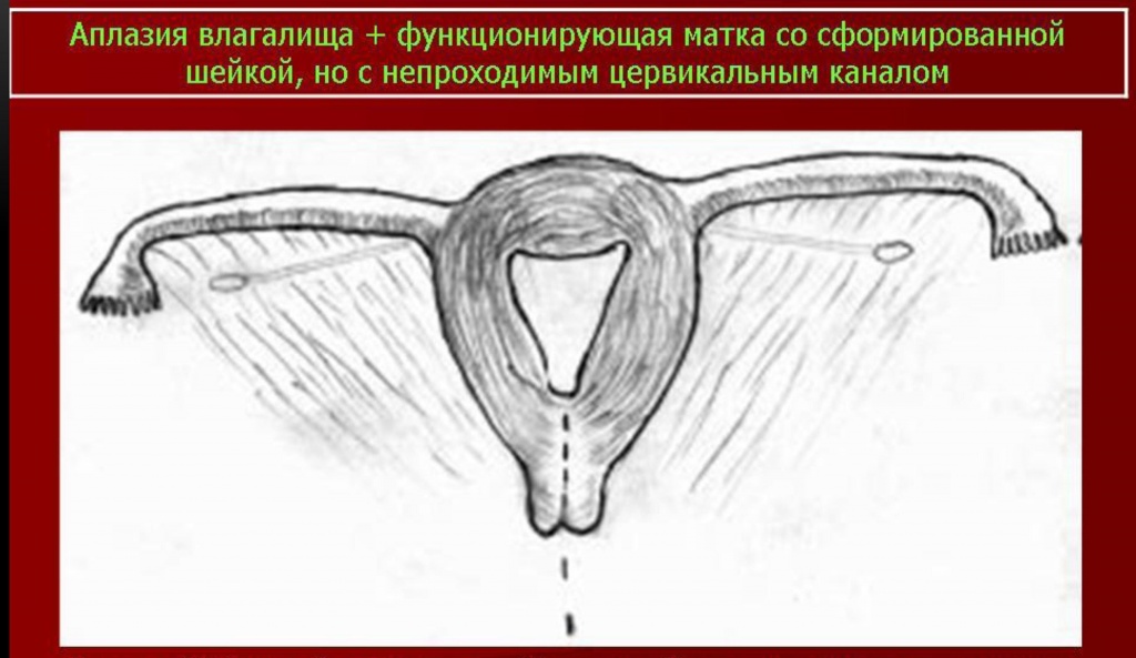 Синдром Майера-Рокитанского-Кюстера - наследственные аномалии развития матки (возможно, аутосомно-доминантное наследование).В анамнезе первичная аменорея, стерильность; нормальное развитие вторичных половых признаков и нормальное появление менструаций. Иногда викарирующие кровотечения из мочевого пузыря, прямой кишки, полости рта или носа. Наружные гениталии: общая гипоплазия, часто дорсальное расположение и воронкообразное расширение отверстий мочеиспускательного канала. Внутренние гениталии — влагалище почти полностью отсутствует; матка обычно разделена на 2 части, без полости, эндометрий отсутствует; яичники расположены относительно высоко, яйцевод гипопластический, но с просветом. Вторичные половые признаки: нормальный женский внешний облик, развитие молочных желез нормальное, оволосение типично для женского пола. Нормальное половое влечение. Овариальная функция: нормальная базальная температура, нормальное содержание прегнандиола и эстрогенов в моче. Нередко сочетается с аномалиями почек и мочевых путей; иногда наблюдаются врожденная аневризма аорты, аномалии мезентерия, сакрализация 5 поясничного позвонка, гипоплазия XII ребра. 