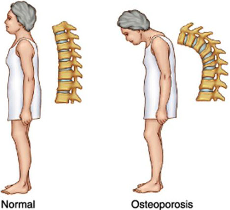 Symptoms-and-Signs-of-Osteoporosis.jpg