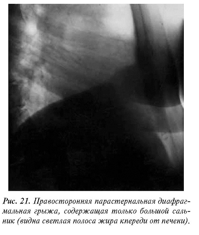 Диафрагмальная грыжа рентгенологическая картина thumbnail