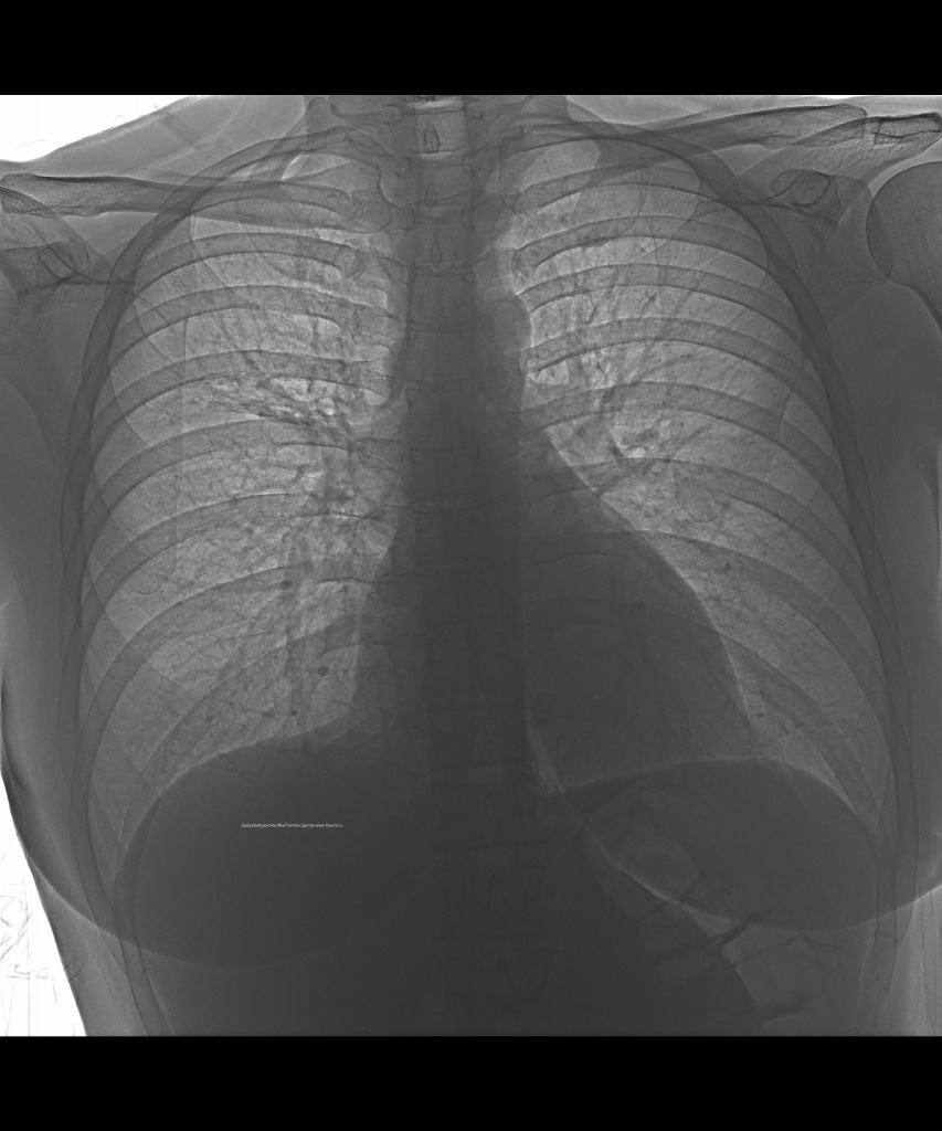 Натуральная женская грудь третьего размера в рентгеновском изображении