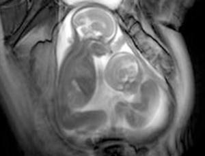 МРТ близнецов в утробе матери