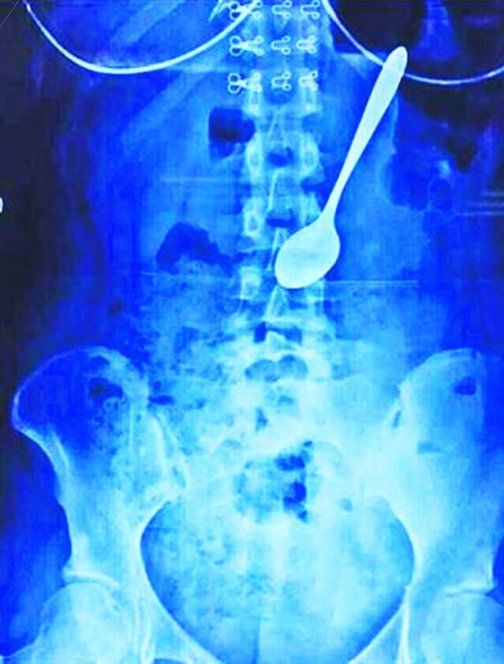 Ложка в желудке на рентгене