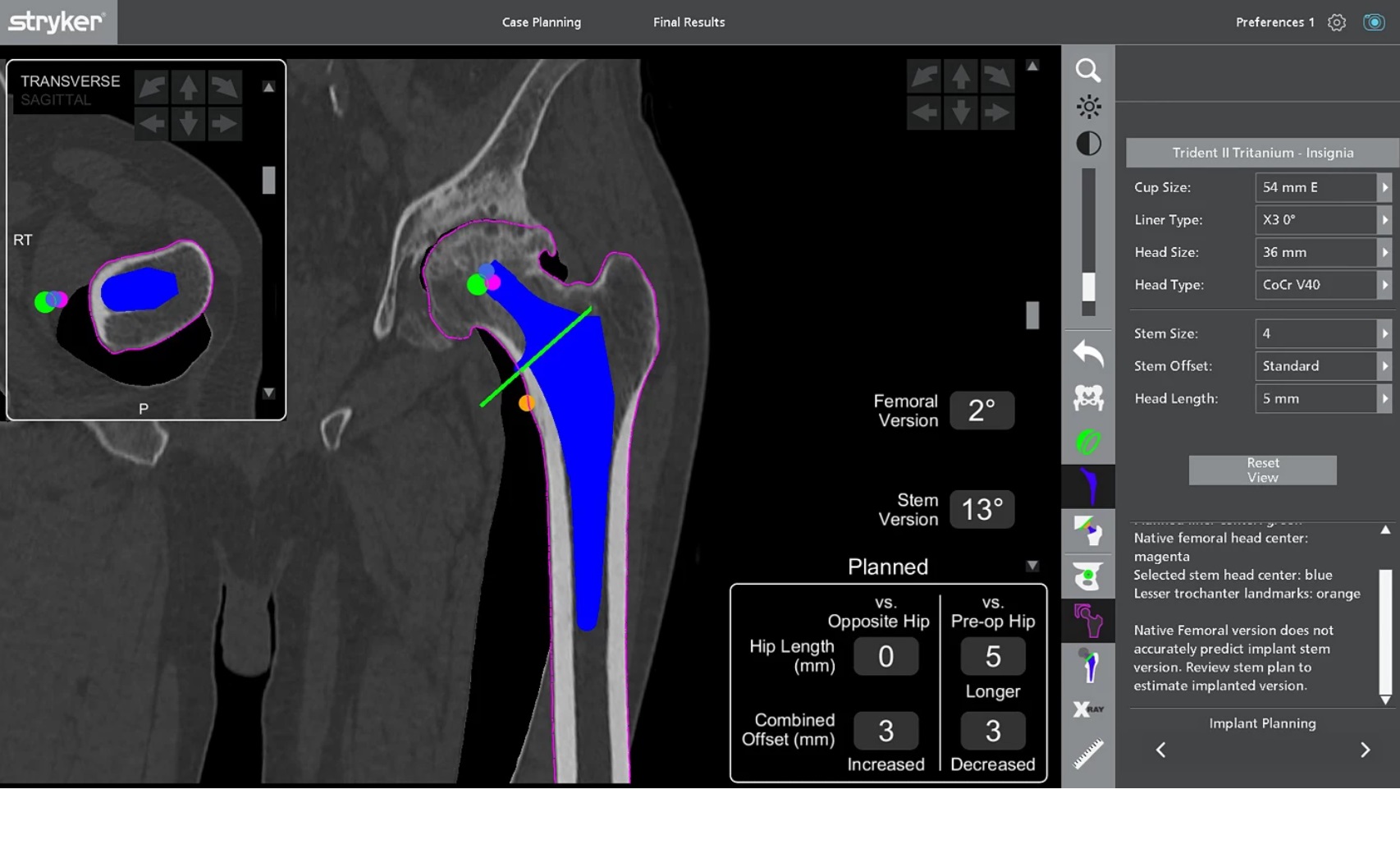 Робот Mako Total Hip обеспечивает точную установку эндопротеза тазобедренного сустава.