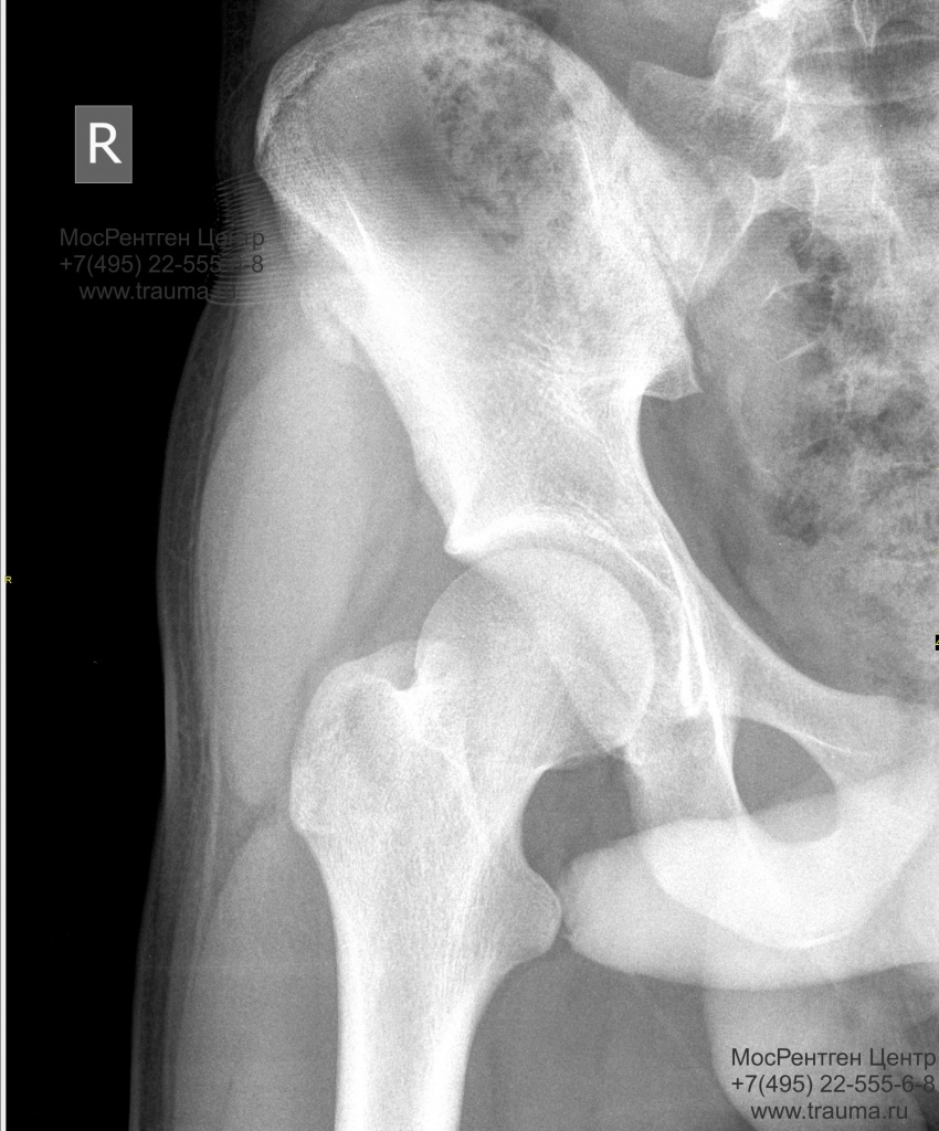 Норма рентгенограммы тазобедренного сустава