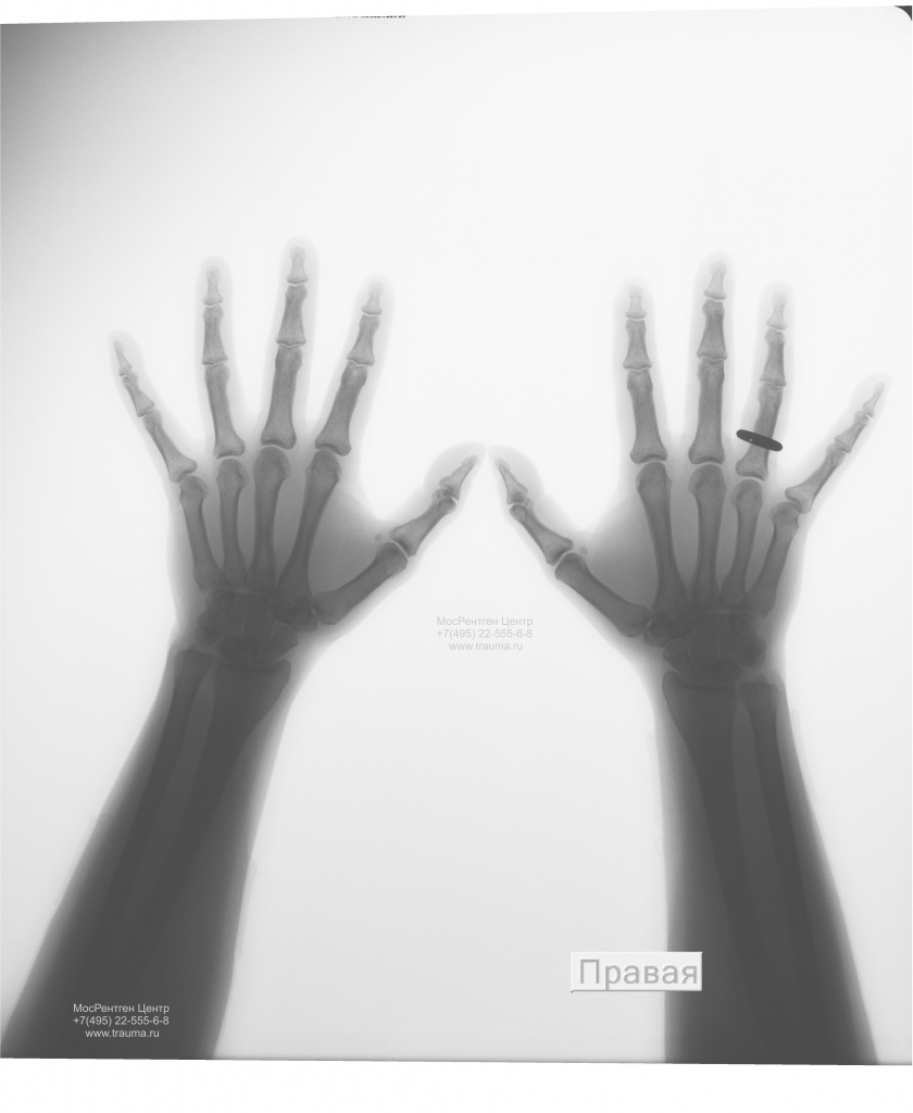 Рентген кистей рук