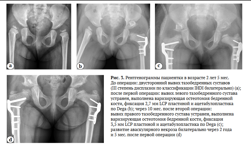 Фиксаторы бедра