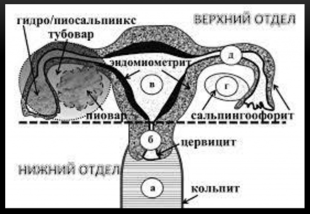 Анатомия женской половой системы с указанием возможных заболеваний