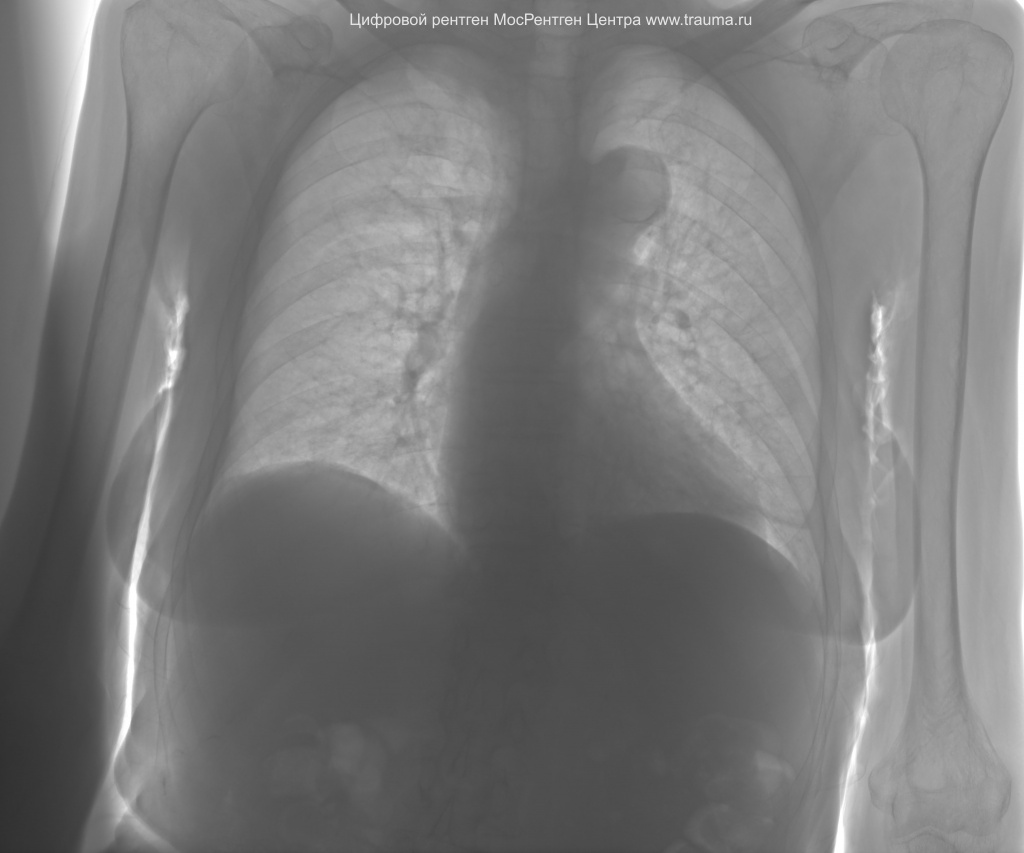 Цифровой рентген на дому грудной клетки