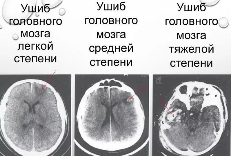 Сотрясение головного мозга, ушиб головного мозга