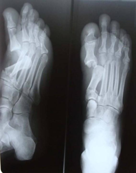 Какие осложнения возможны после перелома пальца ноги?