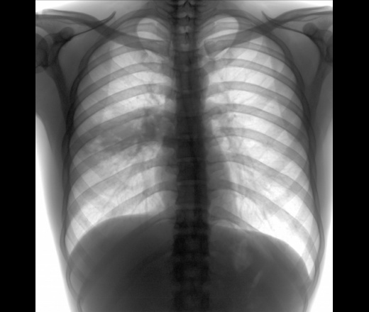 Как выглядит на рентгене нижнедолевая пневмония справа