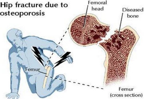 Deadly-Consequences-of-Osteoporosis.jpg